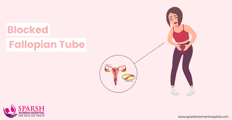 Blocked Fallopian Tubes Symptoms, Causes, and Treatment - Sparsh IVF Hospital Blocked Fallopian Tubes in udaipur, Blocked Fallopian Tubes treatment in udaipur, Blocked Fallopian Tubes treatment cost in udaipur, sparsh ivf hospital