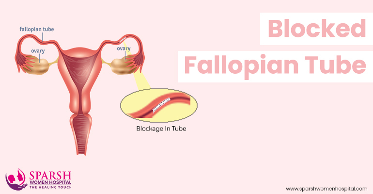 Blocked Fallopian Tubes Symptoms, Causes, and Treatment - Sparsh IVF Hospital