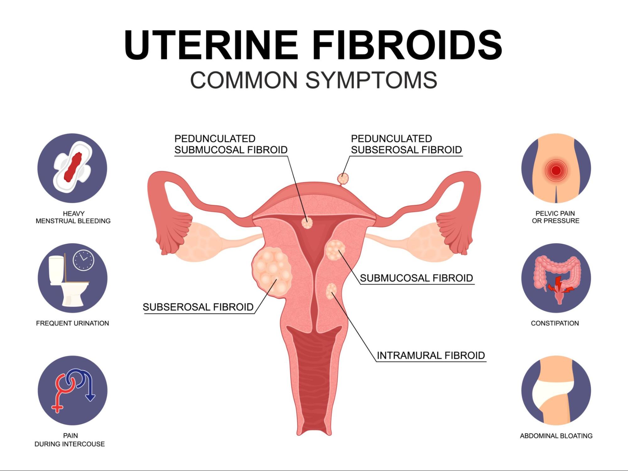 Symptoms of Uterine Pathologies