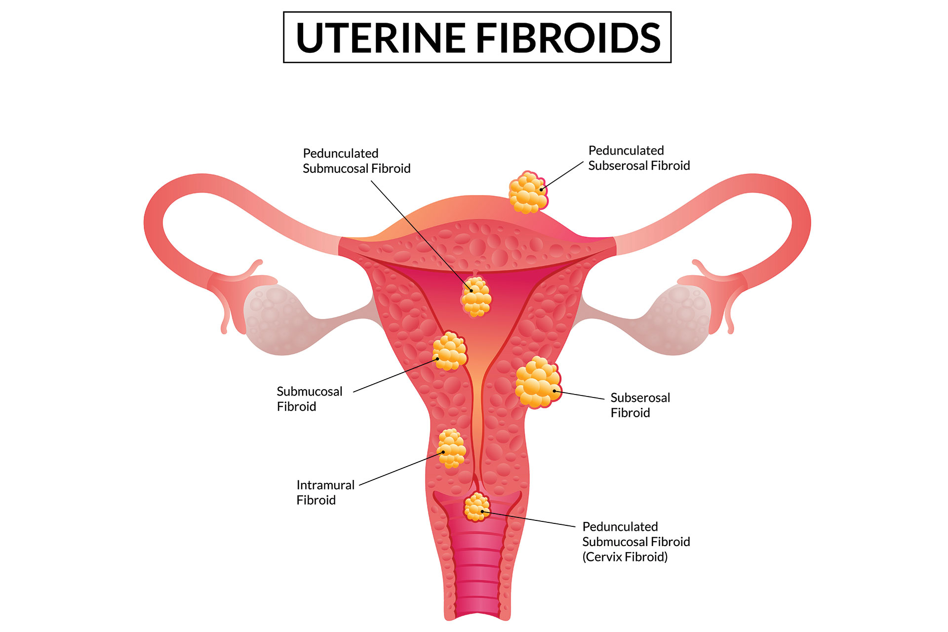 Uterine Pathologies Treatment in Udaipur