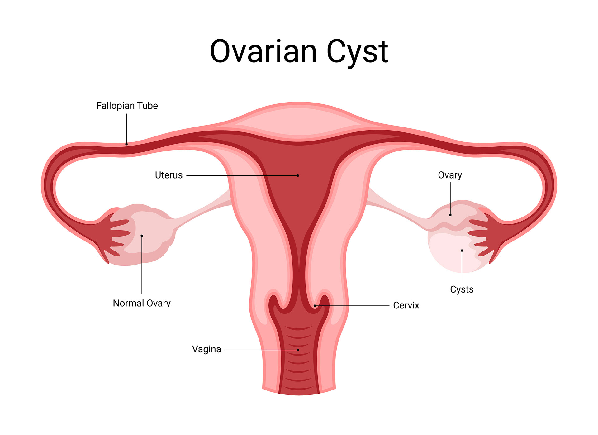 Ovarian Cyst Treatment in Udaipur