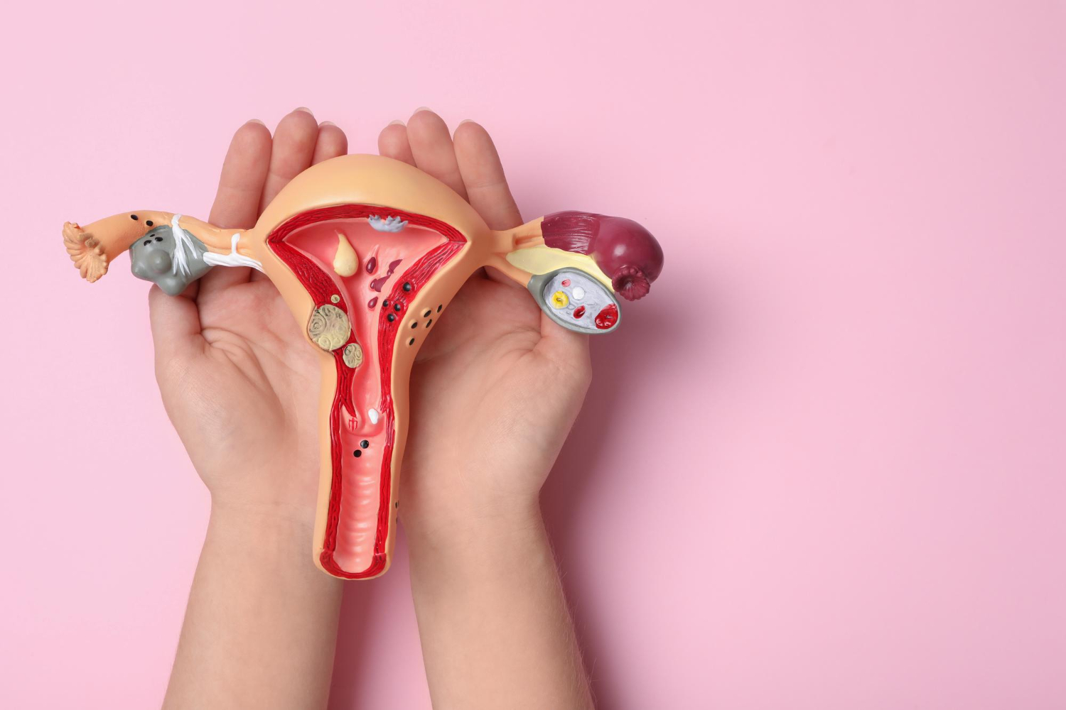 Ovarian Cyst Treatment in Udaipur india