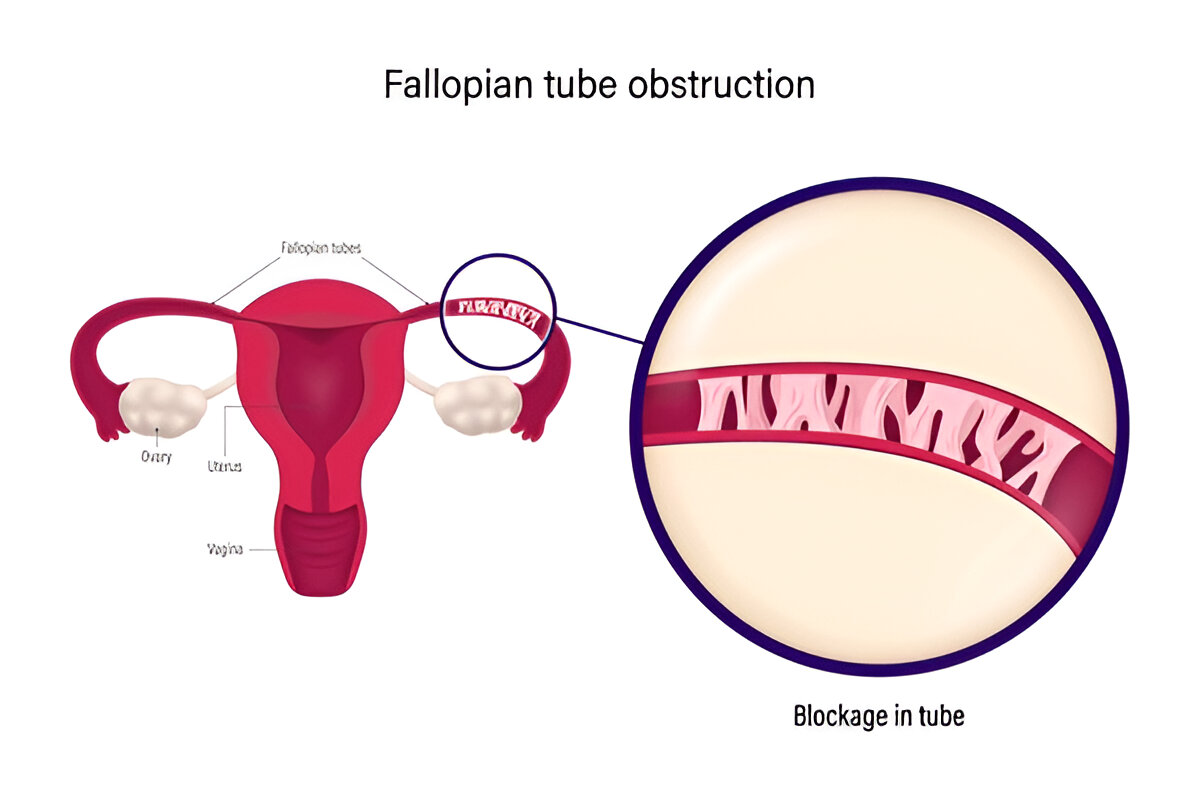 Blocked Fallopian Tubes symptoms