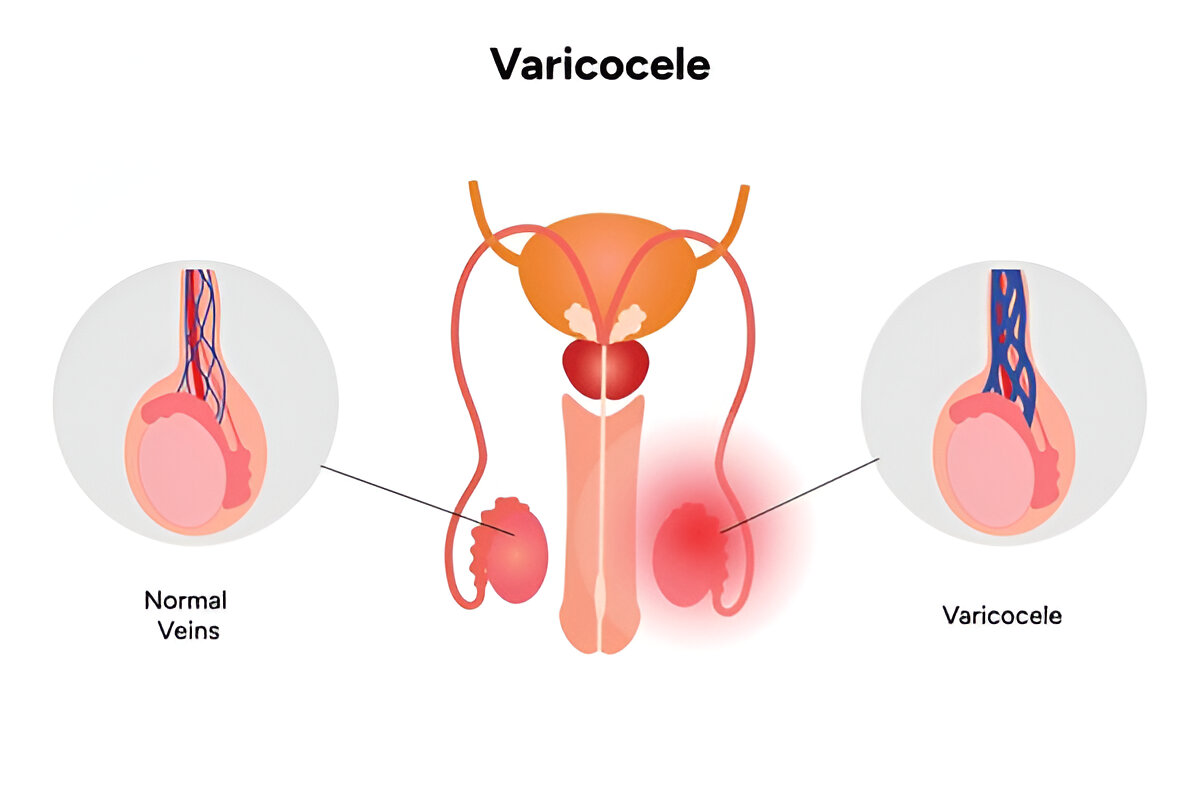 Male Infertility Treatment In Udaipur India