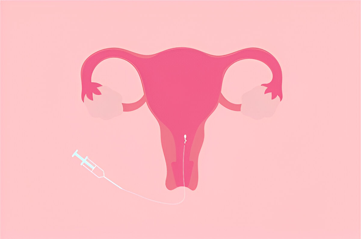 IUI Treatment cost In Udaipur India