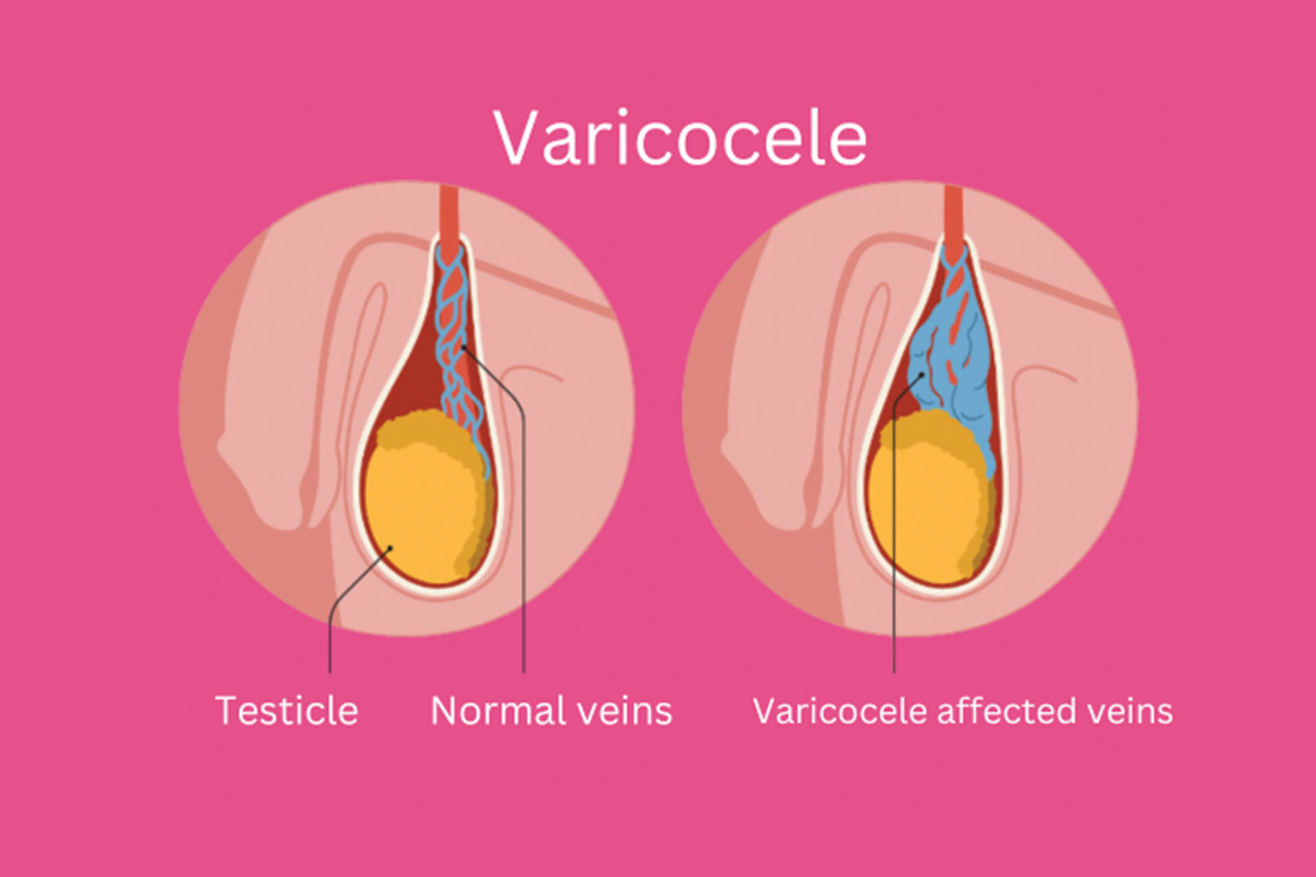 male infertility specialist in udaipur india