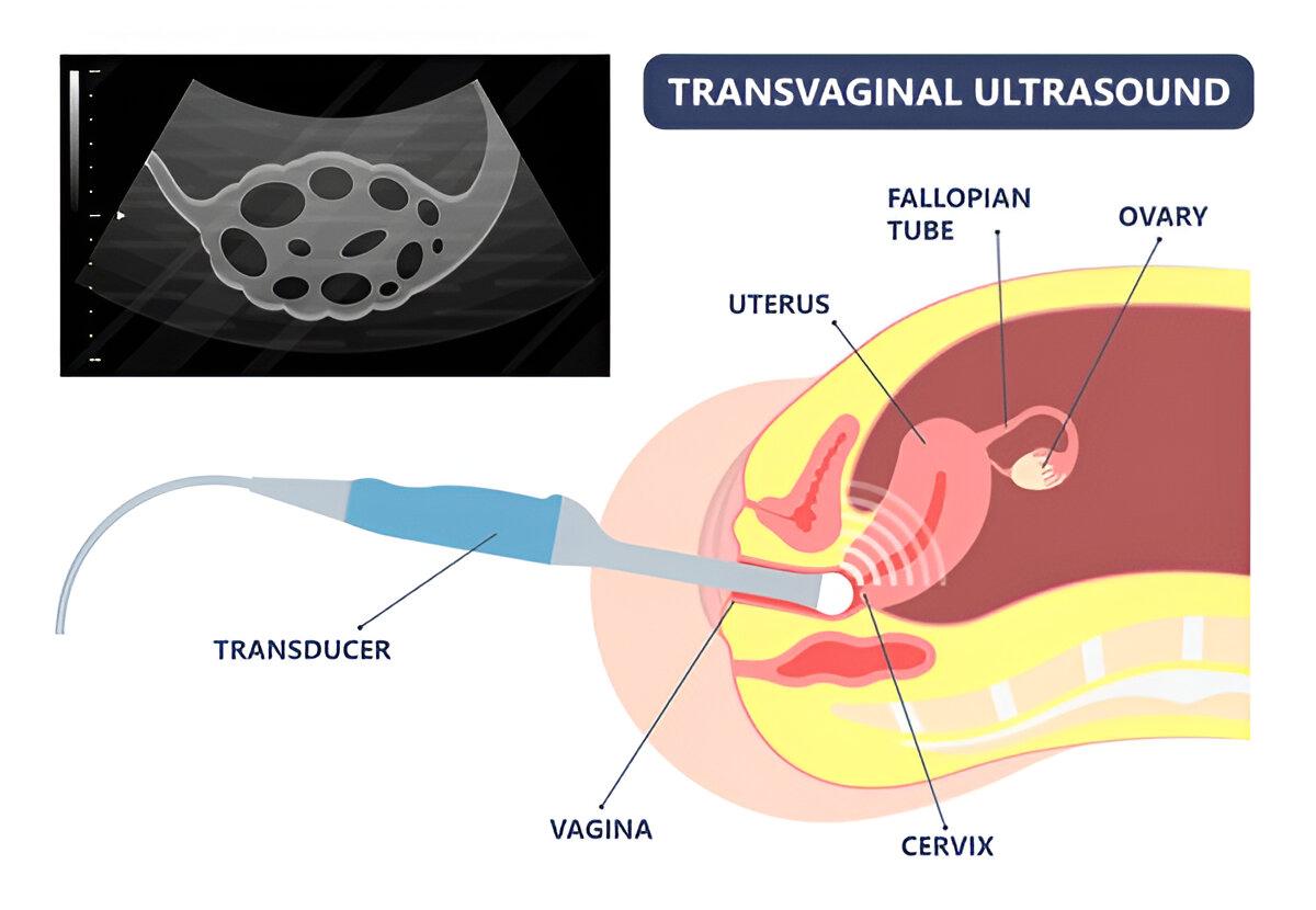 Transvaginal sonography TVS scan for fertility assessment
