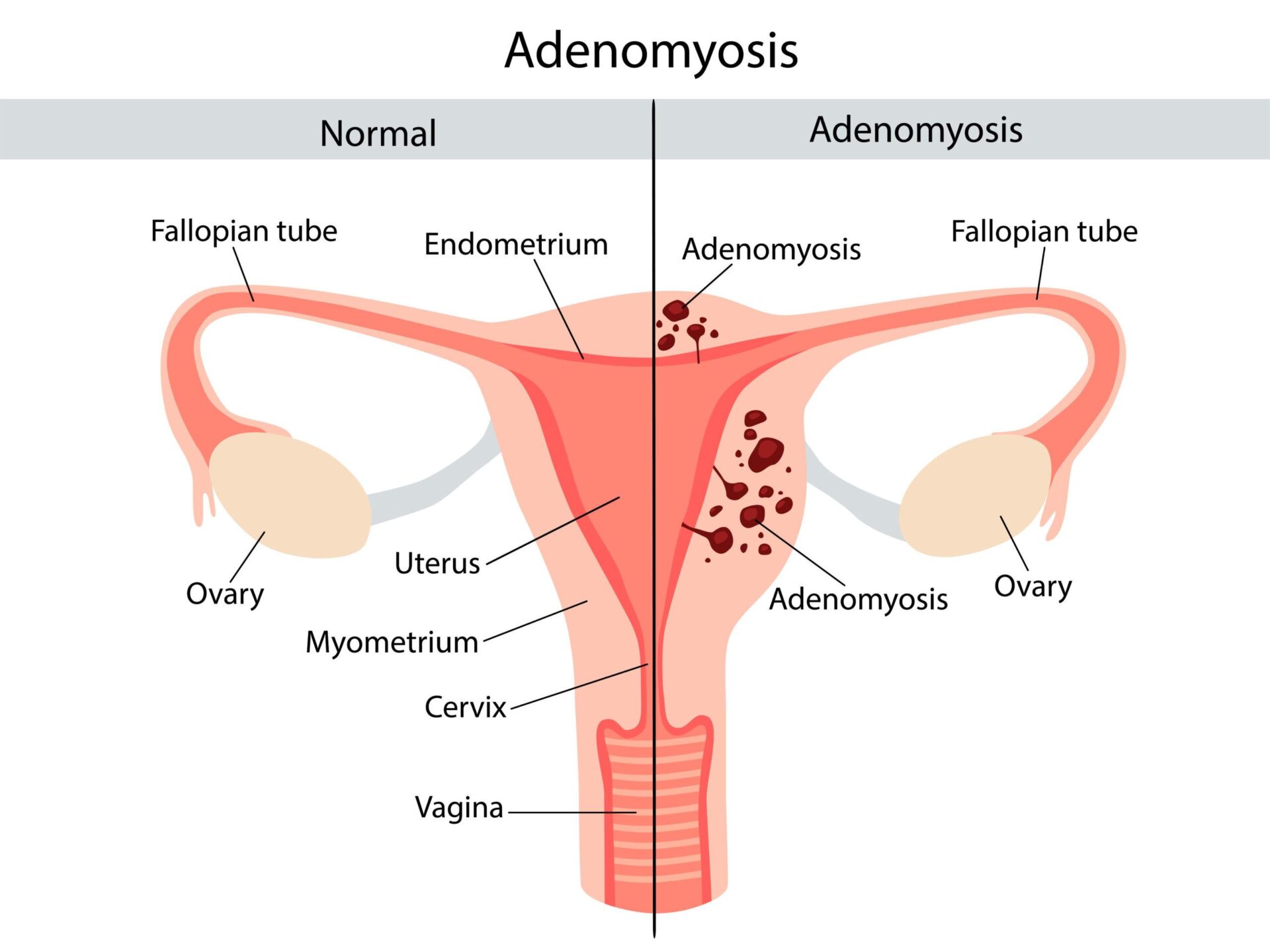 Adenomyosis and Infertility Causes, Impact and Treatment at Sparsh IVF Rajasthan
