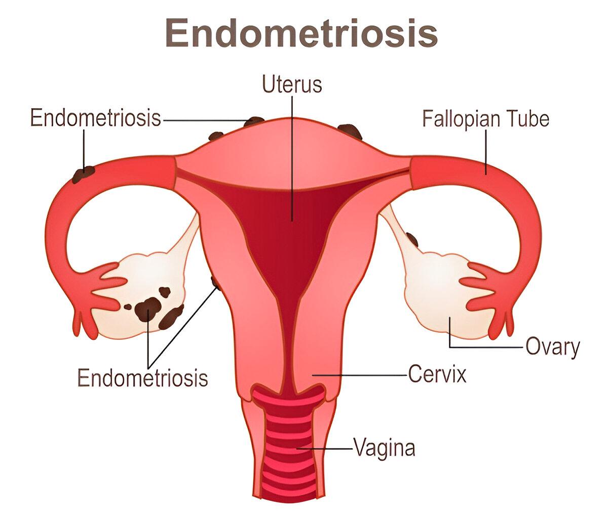 Endometriosis Infertility Treatment & IVF Care at Sparsh IVF