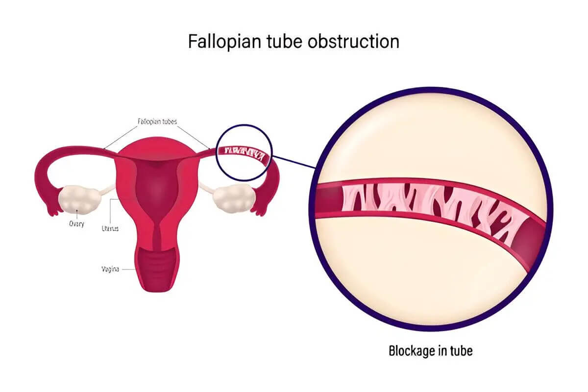 Blocked Fallopian Tubes symptoms