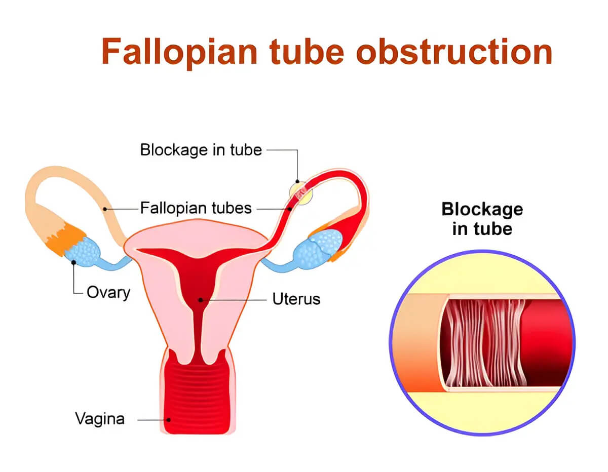 Diagram showing proximal and distal fallopian tube blockage and hydrosalpinx